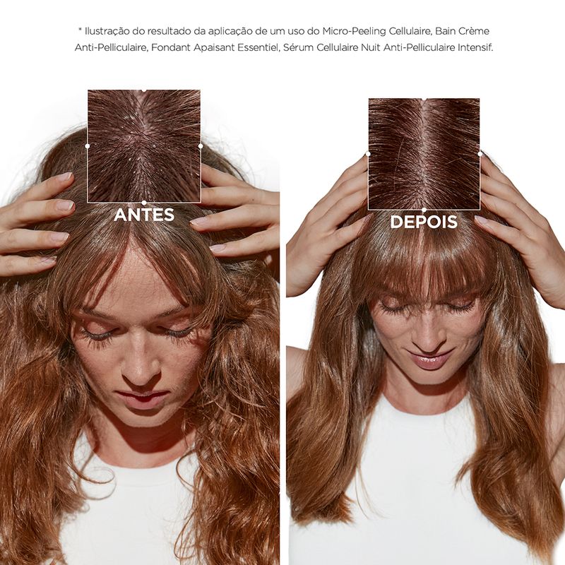 Tratamento-Anticaspa-Kerastase-Symbiose-Micro-Peeling-Cellulaire-200-ml-Antes-e-Depois