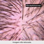 Tratamento-Calmante-Intensivo-L-Oreal-Professionnel-Serie-Expert-Scalp-Advanced-200-ml-Antes-e-Depois