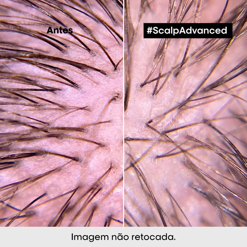 Tratamento-Calmante-Intensivo-L-Oreal-Professionnel-Serie-Expert-Scalp-Advanced-200-ml-Antes-e-Depois