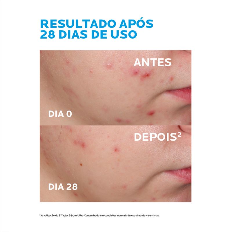 Serum-Facial-Antioleosidade-La-Roche-Posay-Effaclar-Ultra-Concentrado-15-ml-Antes-e-Depois