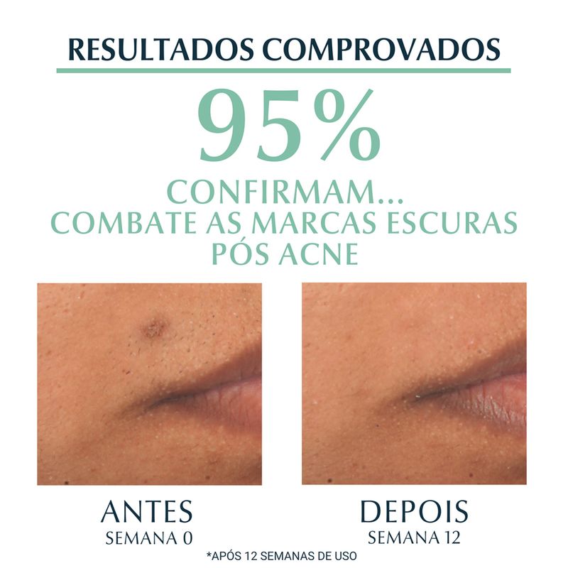 Serum-Facial-Tripla-Acao-com-Thiamidol-Eucerin-Dermo-Pure-Oil-Control-40-ml