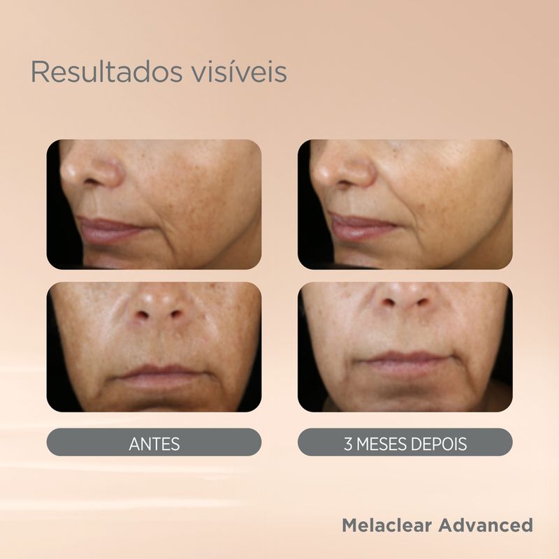 Isdin-Isdinceutics-Melaclear-Advanced-Serum-Facial-Clareador-30-Ml-Refil